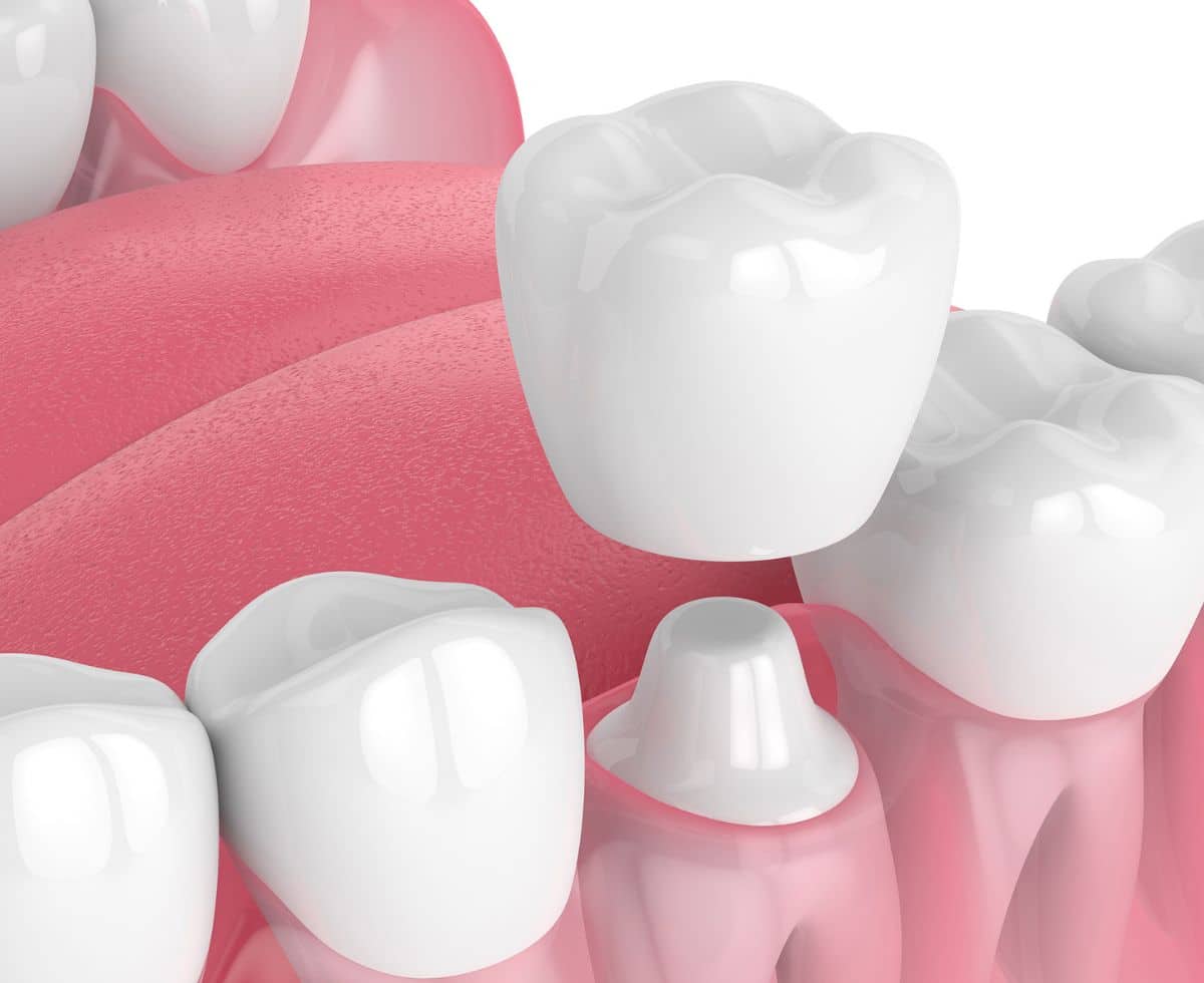 3D rendering of a CEREC dental crown being placed on a tooth, showcasing the dental procedure and technology used for same-day crowns at Hastings Dental Center.