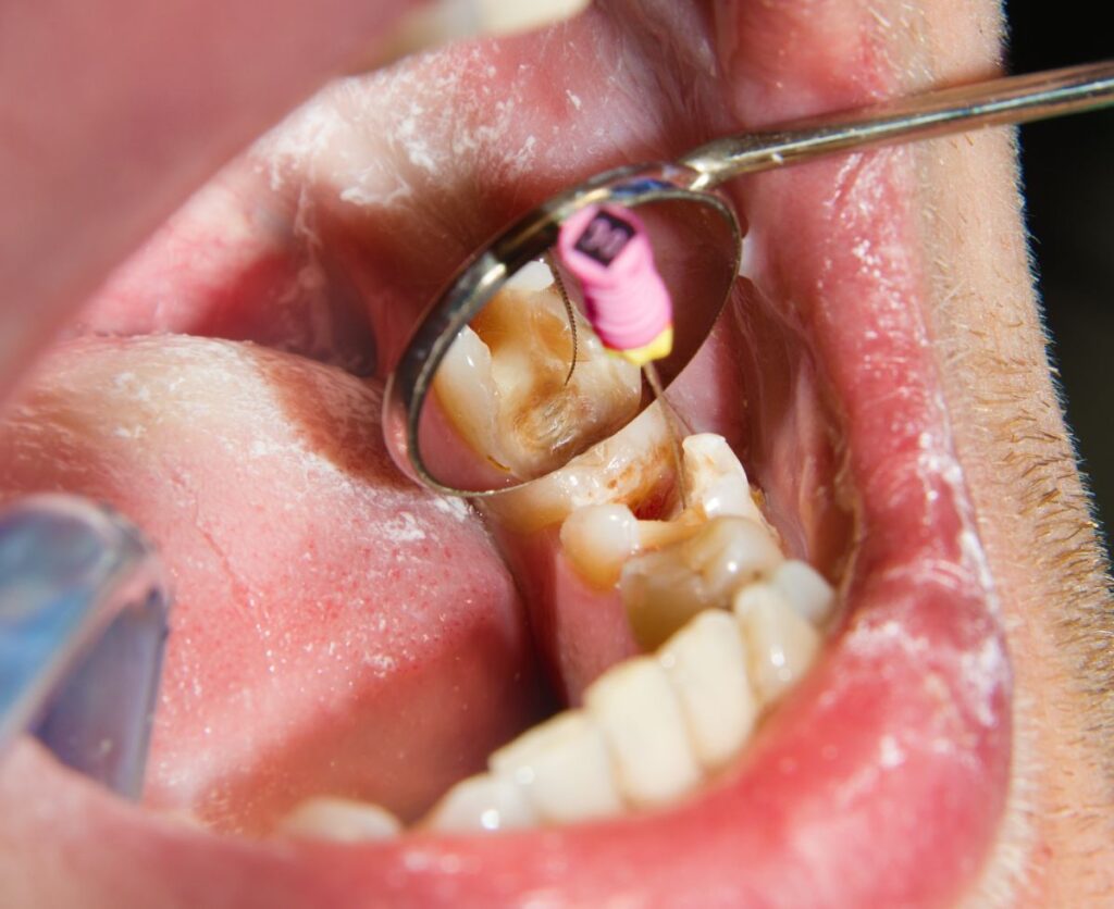 Composite Fillings