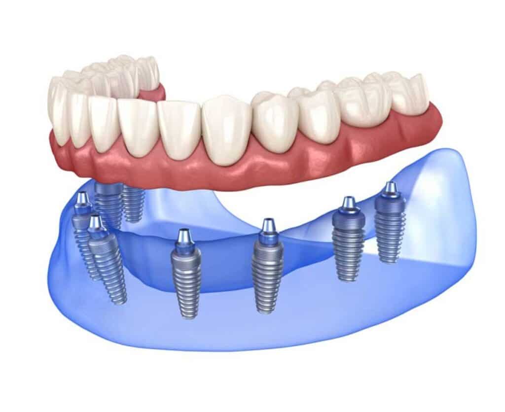Illustration of full arch dental replacement with dental implants, showcasing upper and lower arches with implant fixtures, emphasizing Hastings Dental Center's focus on restorative dental services.