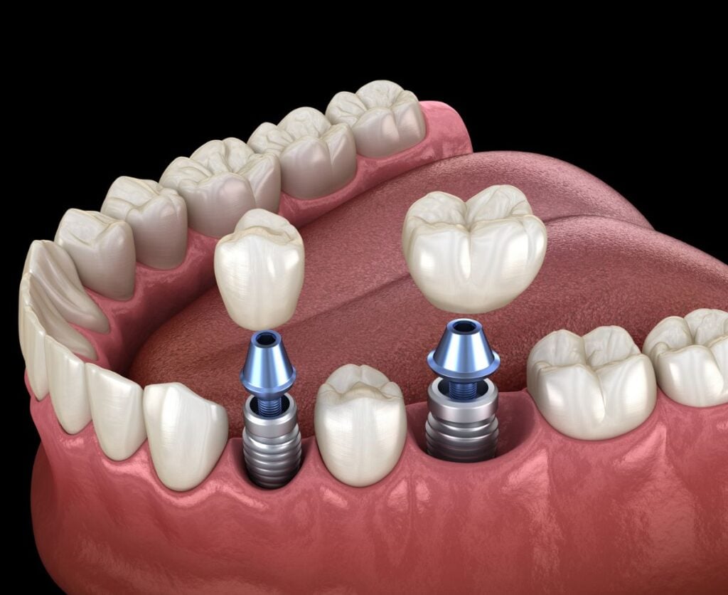 Illustration of dental implants and crowns for multiple tooth replacement, showcasing implant screws and prosthetic teeth in a dental setting.