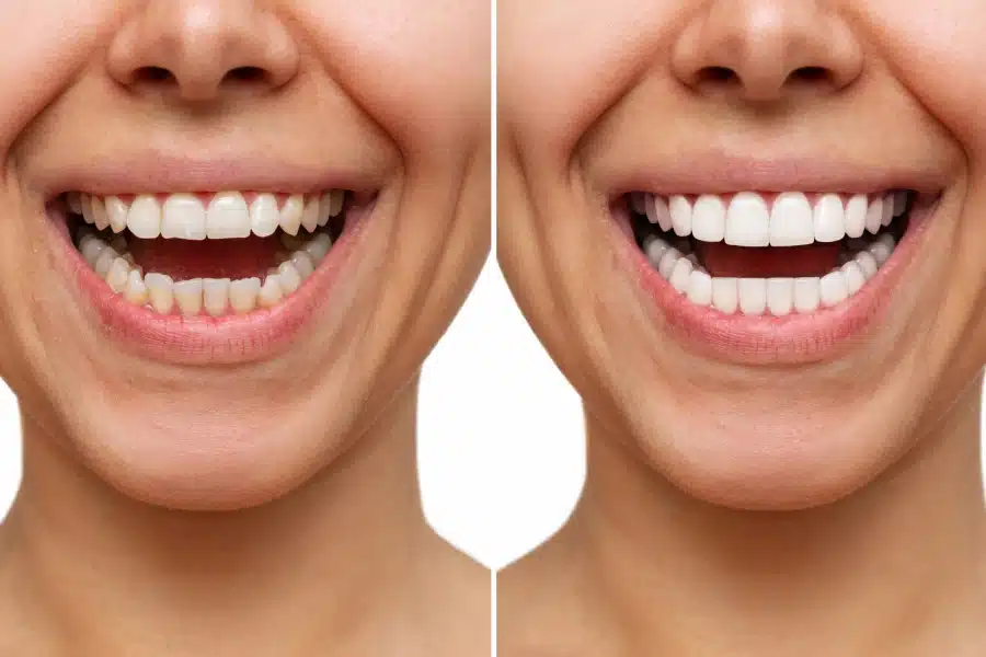 Before and after images of a woman showcasing cosmetic dental transformation with porcelain veneers, highlighting enhanced smile aesthetics and improved teeth appearance.