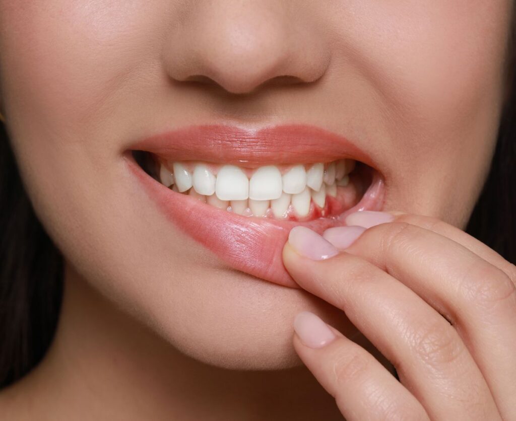 Receding Gums