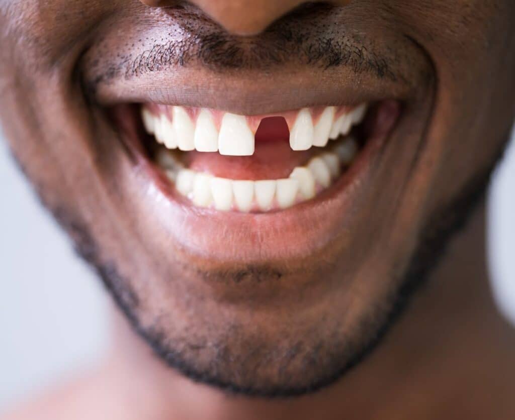 Smiling man with a missing front tooth, highlighting the need for single tooth replacement options like dental implants and bridges at Hastings Dental Center in Vancouver.