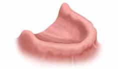 Dental arch model representing full arch replacement options offered by Hastings Dental Center for dental implant procedures.