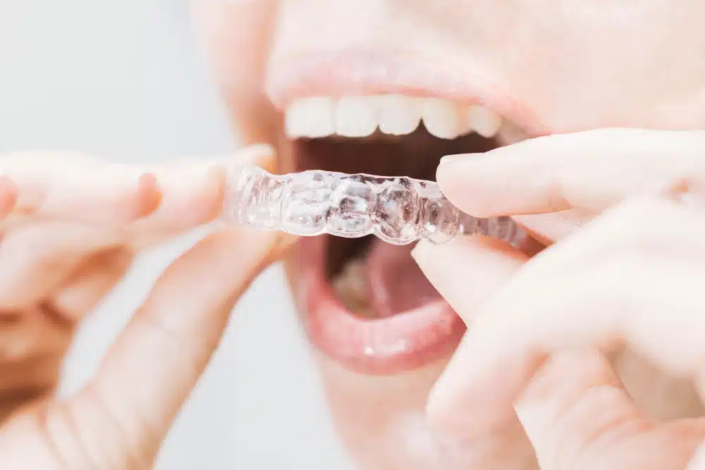 Person placing clear Invisalign aligner in mouth, demonstrating orthodontic treatment options at Hastings Dental Center.