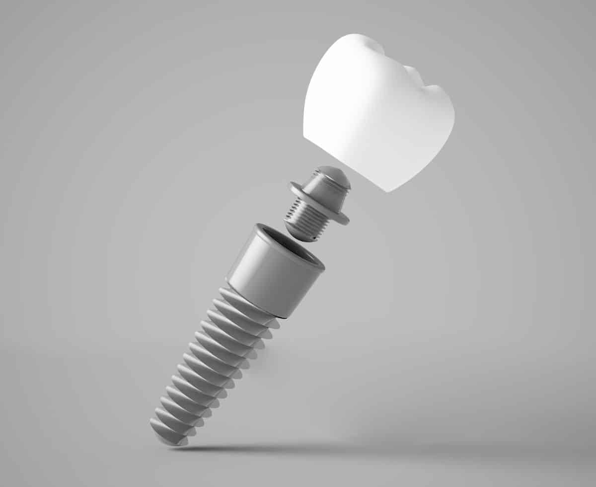 Dental implant components, showcasing a dental screw and crown, relevant to dental implant solutions at Hastings Dental Center.