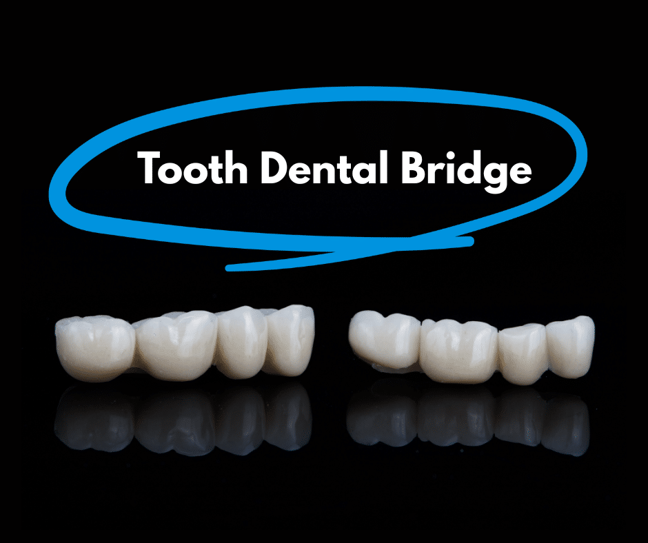 Tooth Dental Bridge Cost in Vancouver