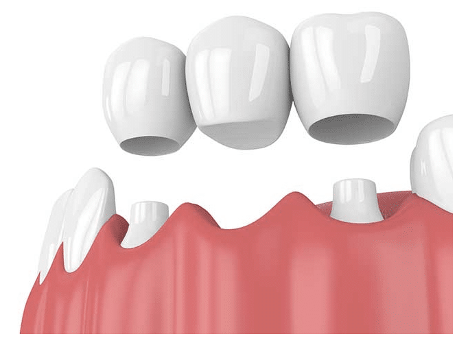 Dental crowns for front teeth, showcasing natural-looking prosthetics and gum line, relevant to Hastings Dental Center's affordable dental services.
