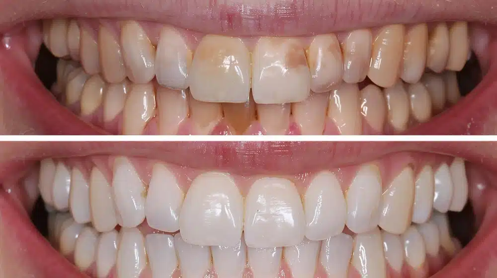 Before-and-after image showcasing teeth veneers transformation, highlighting significant aesthetic improvement in smile appearance at Hastings Dental Center.