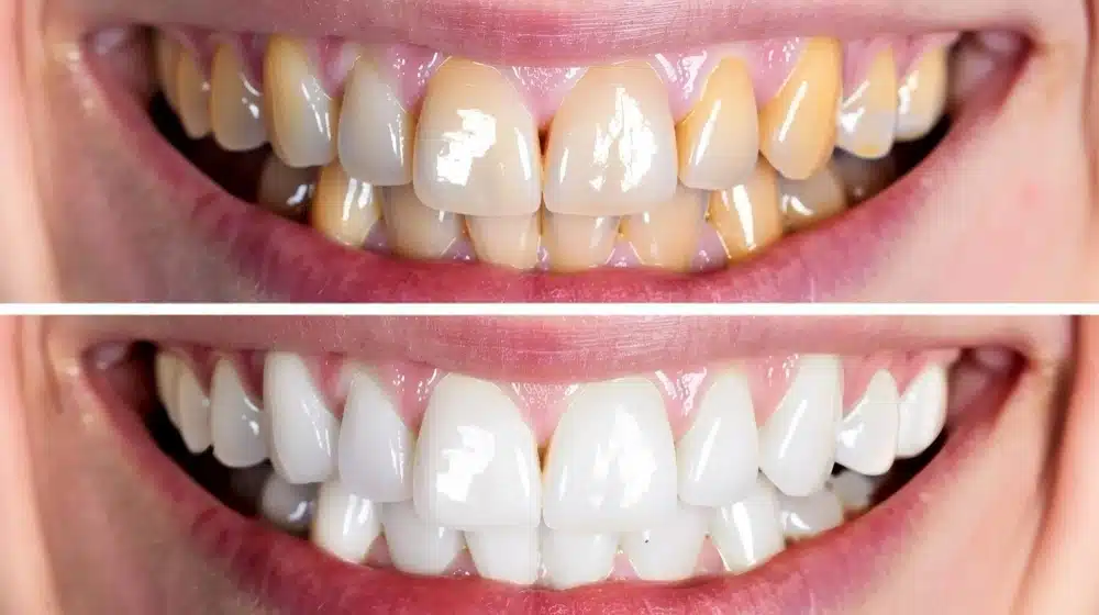 Before and after comparison of teeth whitening results, showcasing stained teeth on top and bright, white teeth on the bottom, illustrating the effectiveness of cosmetic dentistry at Hastings Dental Center.