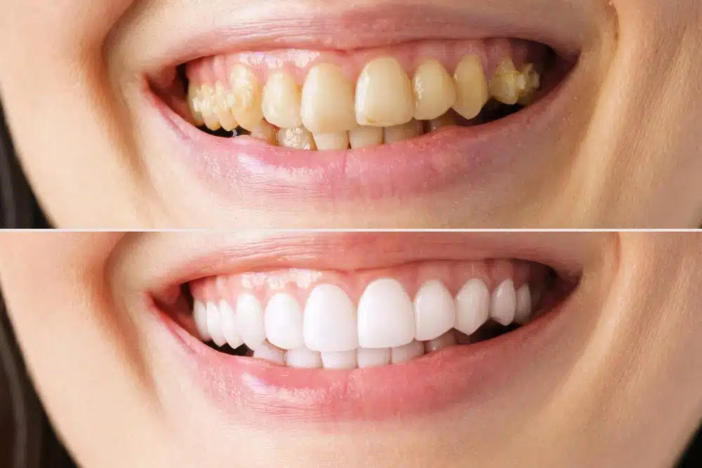 Before-and-after comparison of a smile transformation with teeth veneers, showcasing significant aesthetic improvement from discolored and uneven teeth to bright, straight, and uniform teeth.