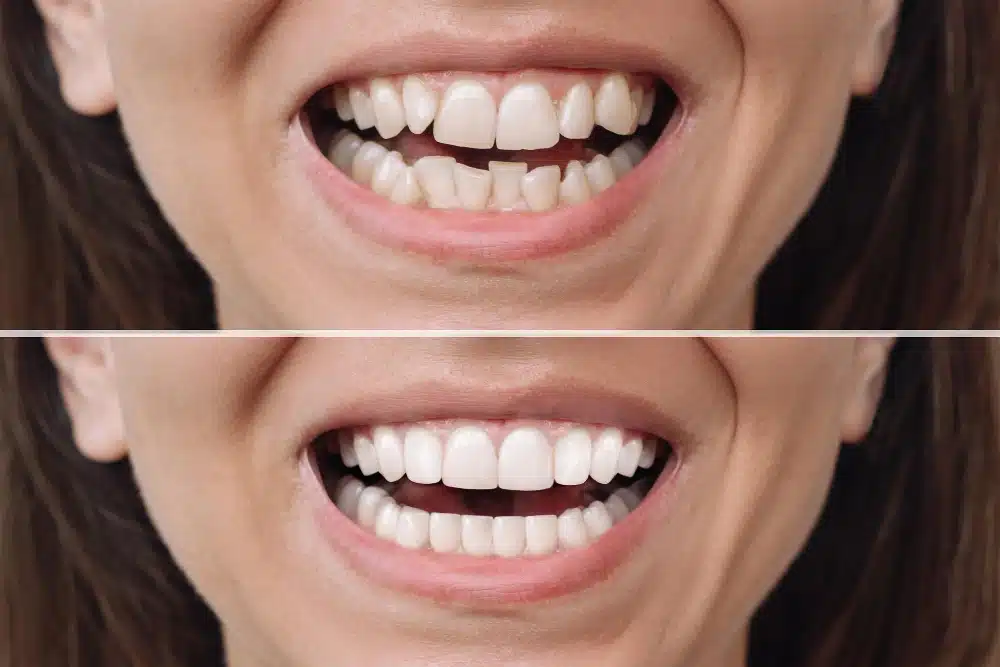 Before-and-after image of a woman's smile transformation showcasing teeth veneers, highlighting improved alignment and brightness at Hastings Dental Center.