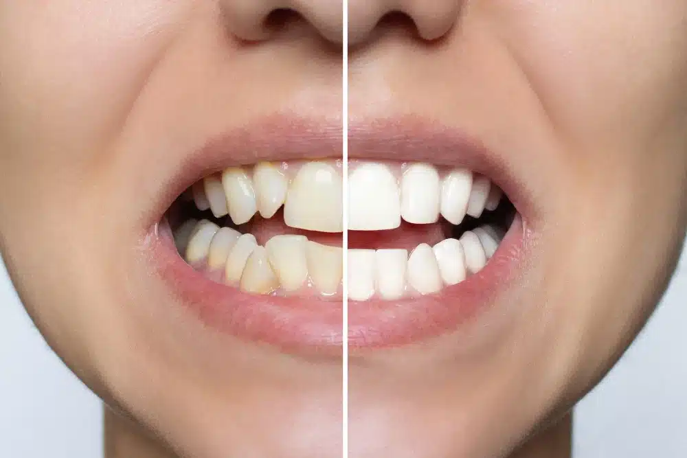 Before-and-after transformation of a smile showing teeth veneers, highlighting significant aesthetic improvement in tooth color and alignment.