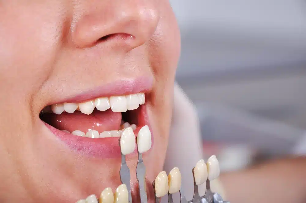 Woman smiling with dental veneers being compared to shade guide, showcasing cosmetic dentistry options at Hastings Dental Center.