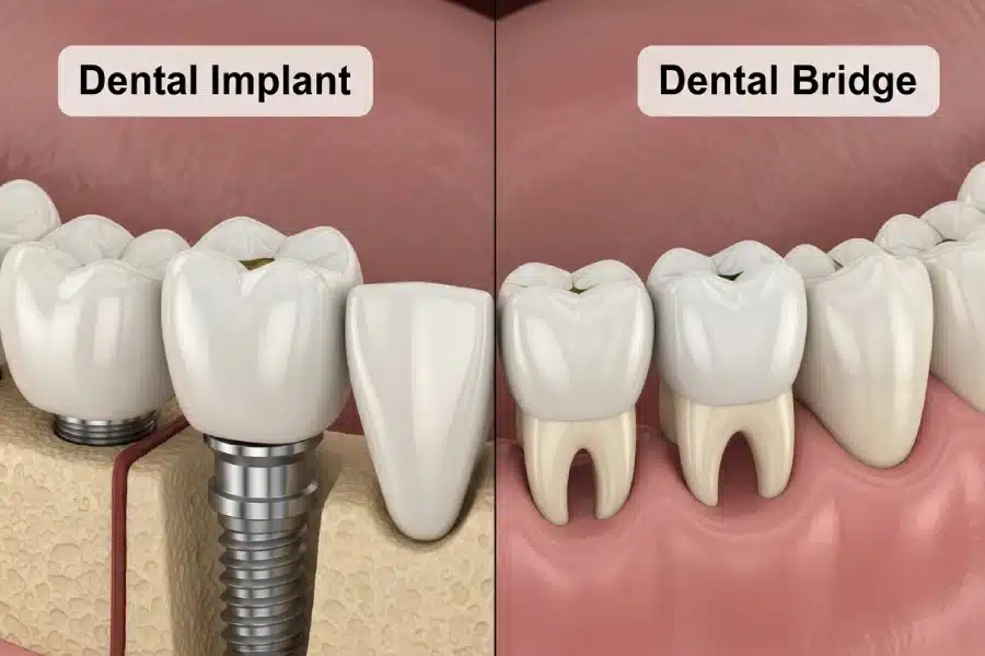 Dental implant on the left with screw base and dental bridge on the right, illustrating tooth replacement options for patients considering dental services at Hastings Dental Center.