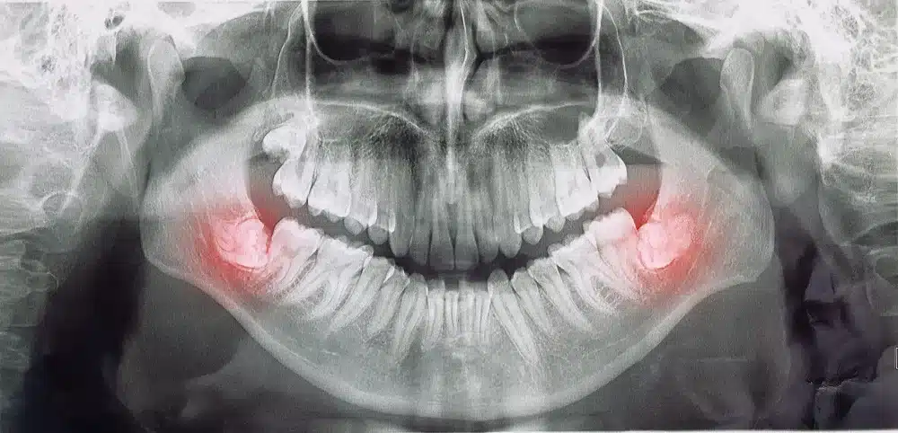 Sore Wisdom Tooth Remedy