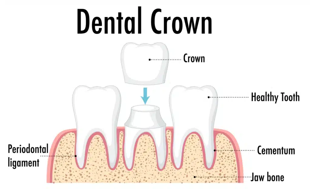 Dental crown diagram illustrating placement on a healthy tooth with labeled components including periodontal ligament, cementum, and jaw bone, relevant to cosmetic and restorative dentistry comparisons.