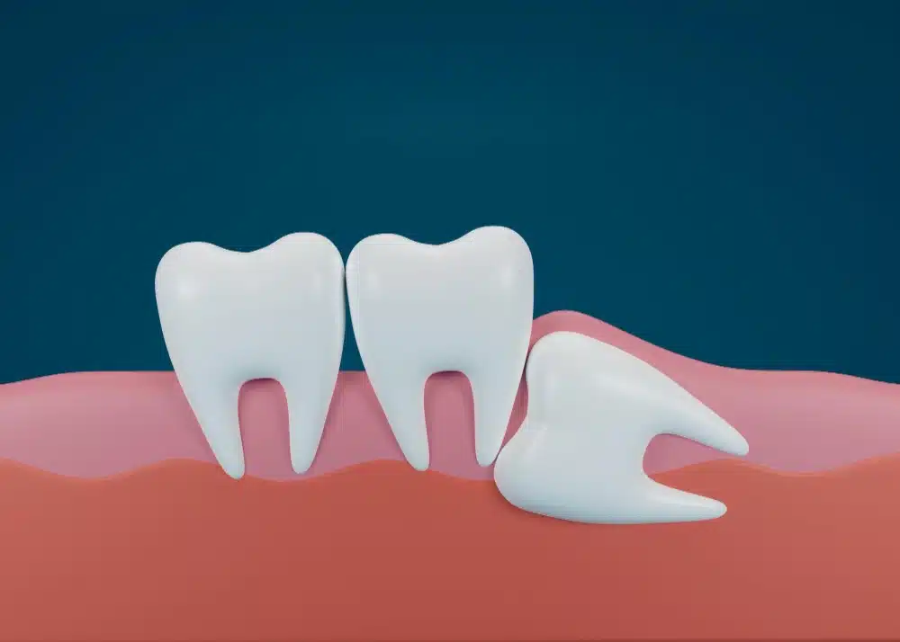 3D illustration of teeth, including two healthy molars and one impacted wisdom tooth, set against a blue background, relevant to wisdom teeth pain management.
