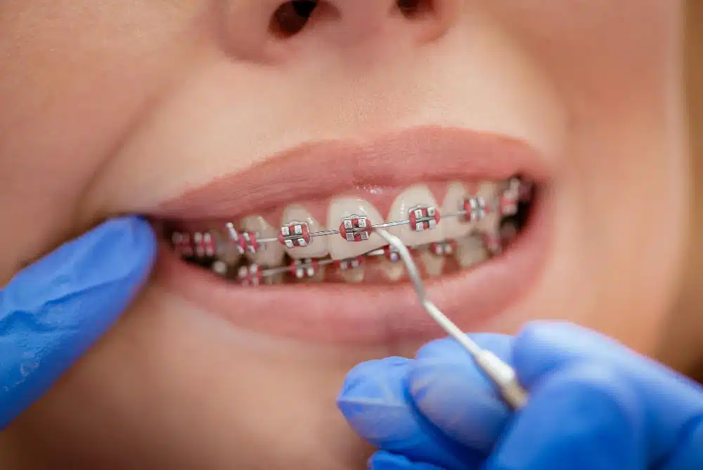 Close-up of a patient with braces, showcasing orthodontic treatment with a dental tool being used to adjust the braces, emphasizing the differences in orthodontic options at Hastings Dental Center.