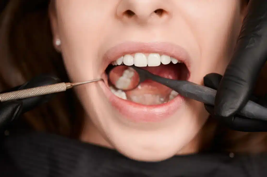 Tooth Enamel Erosion